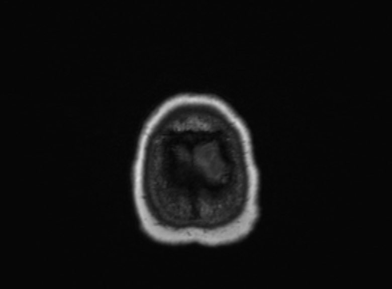 Cerebral ring enhancing lesions - cerebral metastases (Radiopaedia 44922-48817 Axial T1 96).jpg