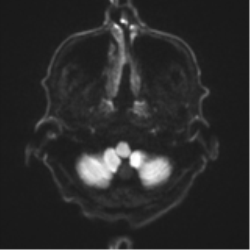 Cerebral toxoplasmosis (Radiopaedia 54575-60804 Axial DWI 38).png
