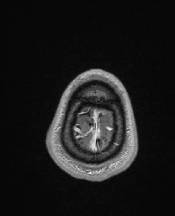 Cerebral toxoplasmosis (Radiopaedia 85779-101597 Axial T1 C+ 151).jpg