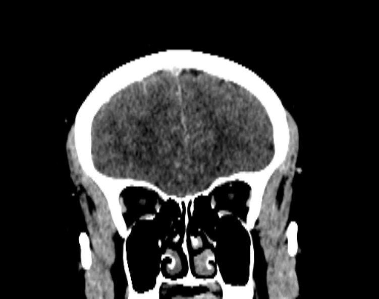 Cerebral venous hemorrhagic infarct from venous sinus thrombosis (Radiopaedia 55433-61883 Coronal C+ delayed 20).jpg