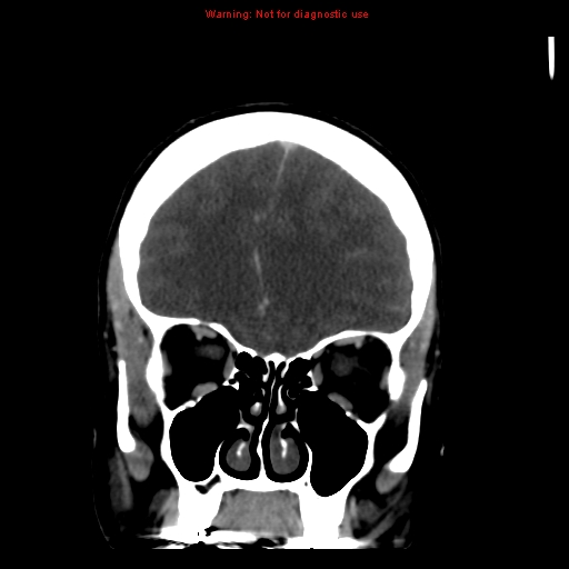 Cerebral venous infarction (Radiopaedia 12404-20735 B 19).jpg