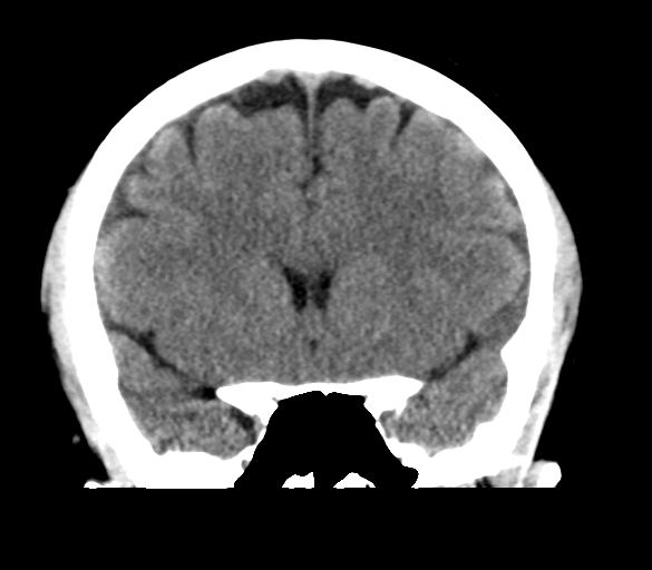 File:Cerebral venous infarction due to transverse sinus thrombosis (Radiopaedia 34688-36116 Coronal non-contrast 15).png