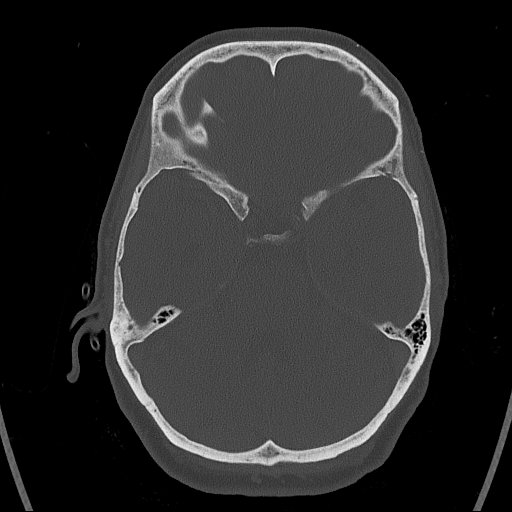 Cerebral venous infarction with hemorrhage (Radiopaedia 65343-74381 Axial bone window 47).jpg