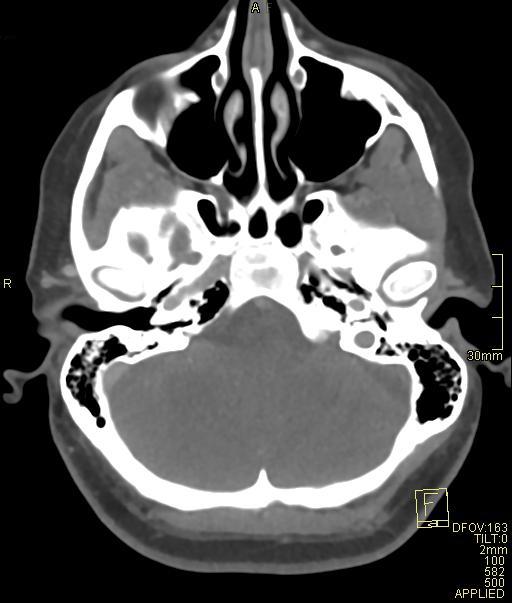 Cerebral venous sinus thrombosis (Radiopaedia 91329-108965 Axial venogram 19).jpg