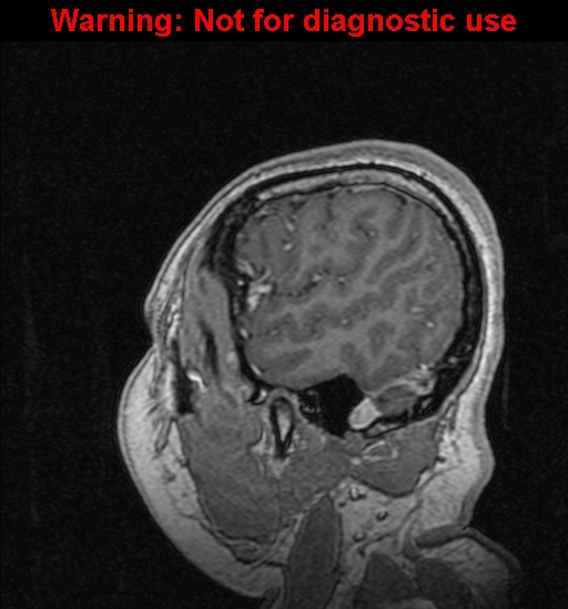 Cerebral venous thrombosis (Radiopaedia 37224-39208 Sagittal T1 C+ 129).jpg