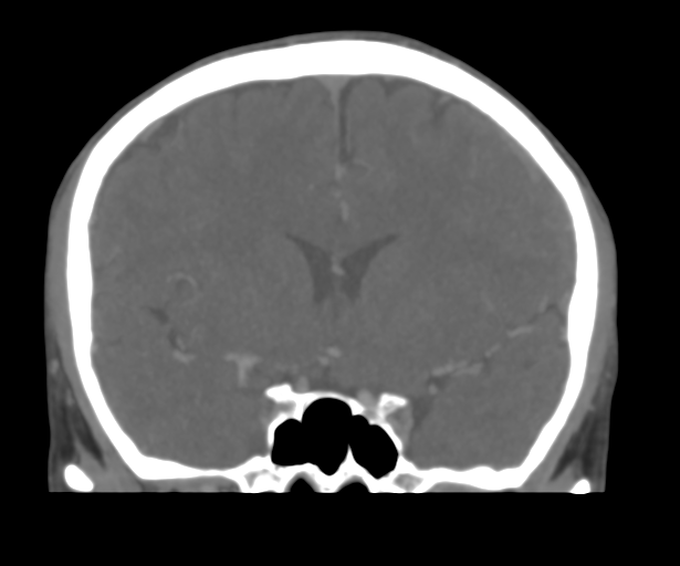 File:Cerebral venous thrombosis (Radiopaedia 38392-40467 Coronal CTA-Venogram 26).png