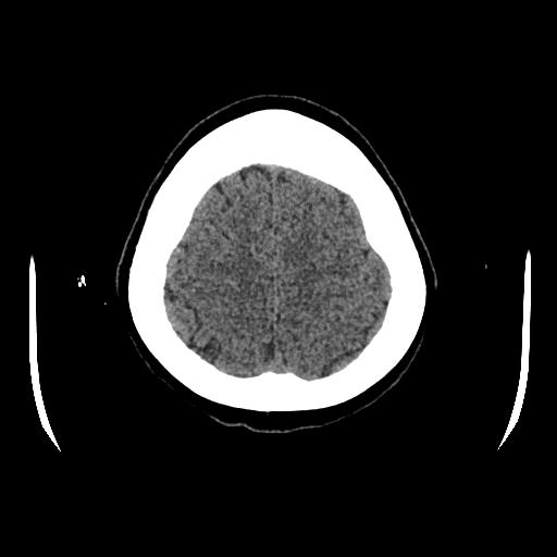 Cerebral venous thrombosis with venous hemorrhagic infarct (Radiopaedia 90354-107660 Axial non-contrast 43).jpg