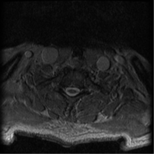 Cervical canal stenosis with cord compression (Radiopaedia 34114-35374 Axial Gradient Echo 15).png