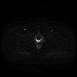 Cervical carcinoma (Radiopaedia 85405-101028 Axial DWI 21).jpg