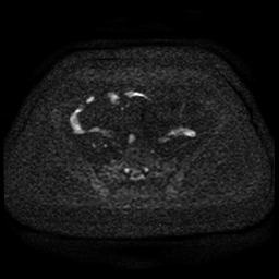 Cervical carcinoma (Radiopaedia 85405-101028 Axial DWI 58).jpg