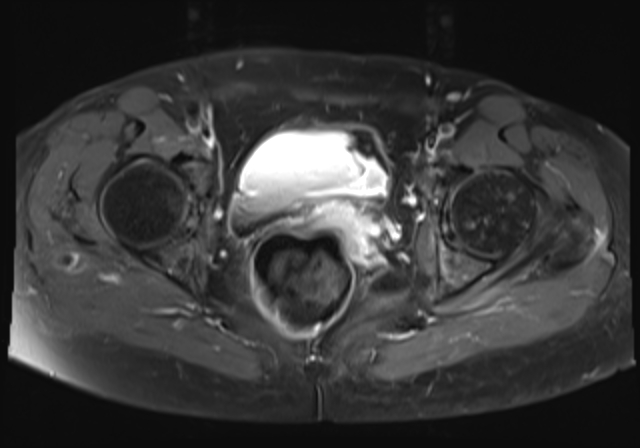 File:Cervical carcinoma (Radiopaedia 88312-104943 Axial T1 C+ fat sat 15).jpg