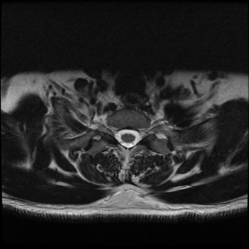 File:Cervical disc extrusion (Radiopaedia 59074-66364 Axial T2 19).jpg