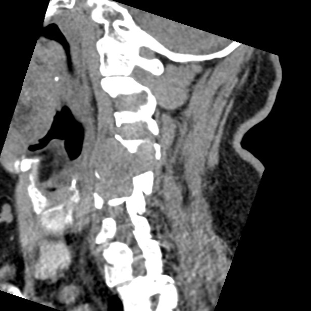 Cervical spinal neurofibroma in a patient with NF1 (Radiopaedia 58344-65464 C 19).jpg