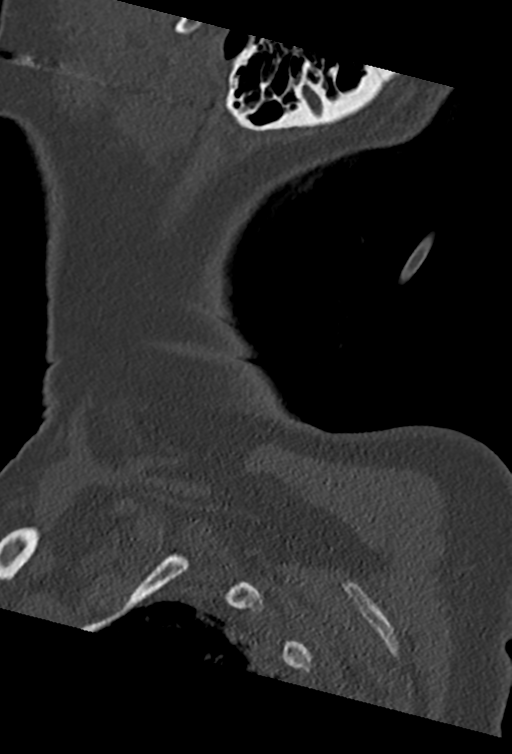 Cervical spine ACDF loosening (Radiopaedia 48998-54070 Sagittal bone window 80).png