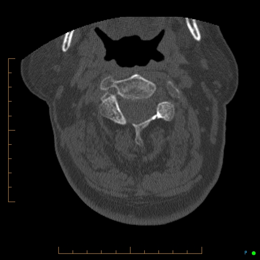 Cervical spine fracture - ankylosing spondylitis (Radiopaedia 76835-88706 Axial bone window 65).jpg