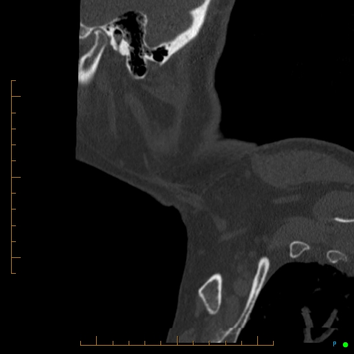 Cervical spine fracture - ankylosing spondylitis (Radiopaedia 76835-88706 Sagittal bone window 114).jpg