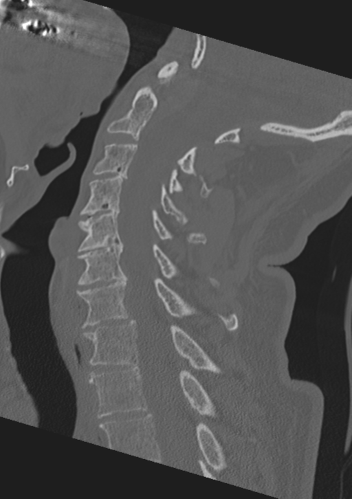 Cervical spine fractures with vertebral artery dissection (Radiopaedia 53296-59268 Sagittal bone window 31).png