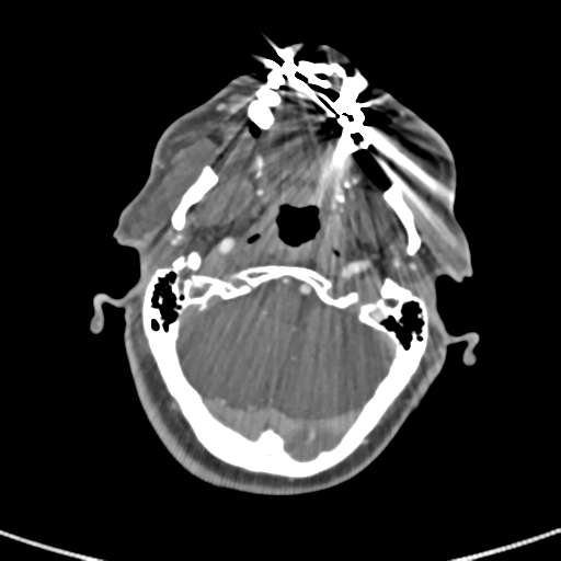 File:Cervical spine fractures with vertebral artery dissection (Radiopaedia 53296-59269 A 78).png