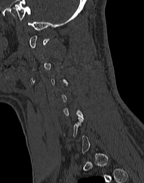 Cervical spondylodiscitis (Radiopaedia 28057-29489 Sagittal bone window 48).jpg