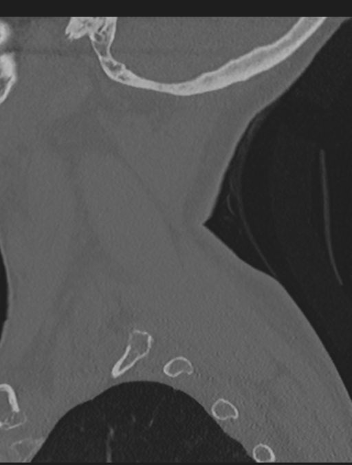 Cervical spondylolysis (Radiopaedia 49616-54811 Sagittal bone window 9).png