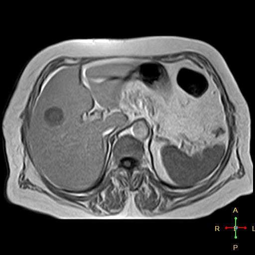 File:Cervical stump squamous cell carcinoma (Radiopaedia 48049-52858 H 10).jpg