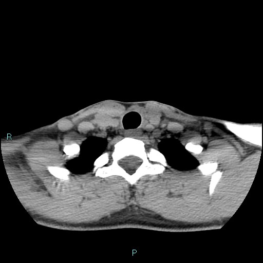 Cervical thymic cyst (Radiopaedia 88632-105335 Axial non-contrast 34).jpg