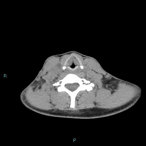 Cervical thymic cyst (Radiopaedia 88632-105335 Axial non-contrast 47).jpg