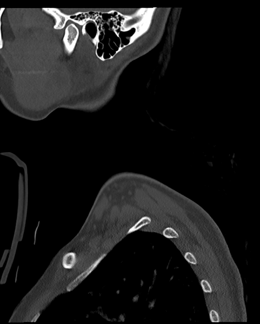 Cervical tuberculous spondylitis (Radiopaedia 39149-41365 Sagittal bone window 3).png