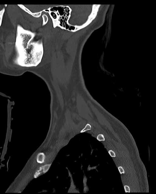 Cervical tuberculous spondylitis (Radiopaedia 39149-41365 Sagittal bone window 8).png