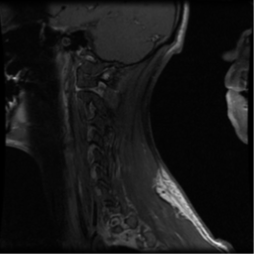 File:Cervical vertebrae metastasis (Radiopaedia 78814-91667 G 2).png