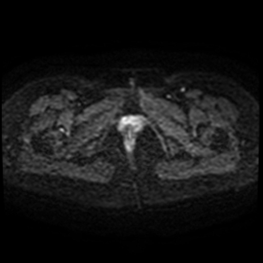 Cesarian section scar endometriosis (Radiopaedia 66520-75799 Axial DWI 50).jpg