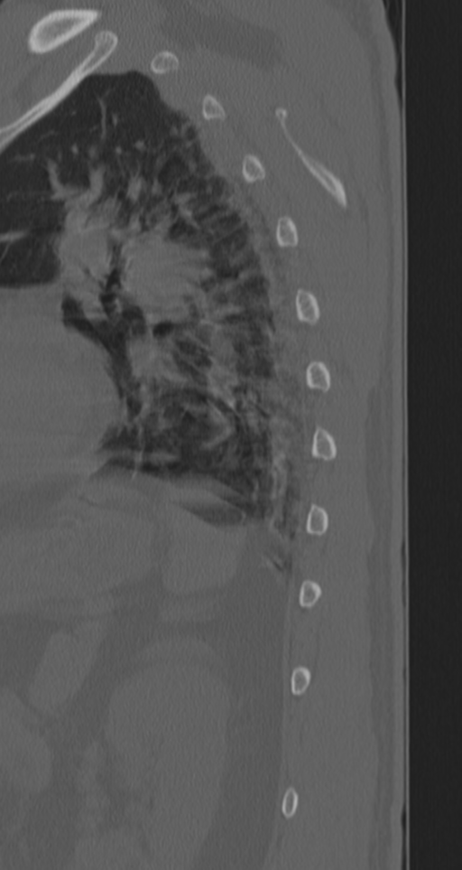 Chance fracture (Radiopaedia 33854-35020 Sagittal bone window 10).png