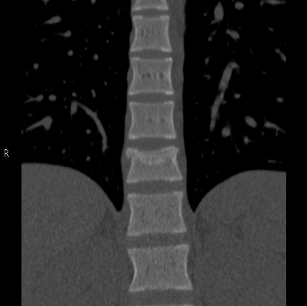 File:Chance fracture (Radiopaedia 36521-38081 Coronal bone window 12).jpg
