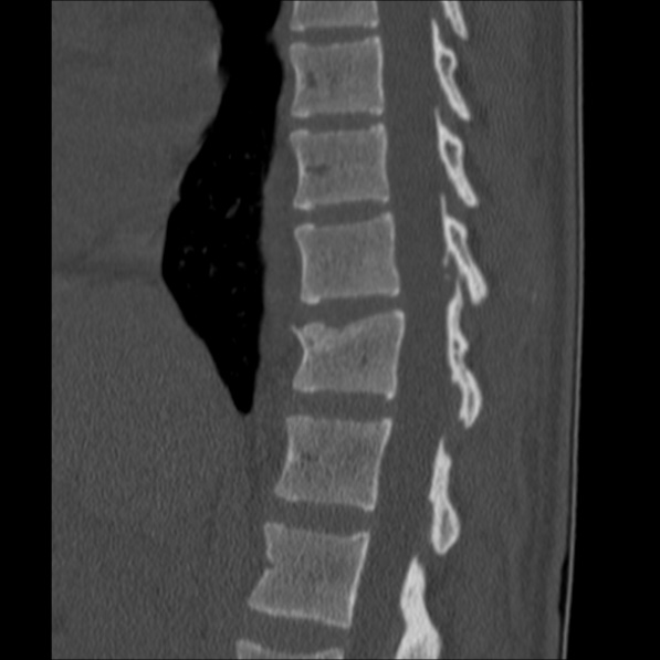 Chance fracture (Radiopaedia 36521-38081 Sagittal bone window 26).jpg