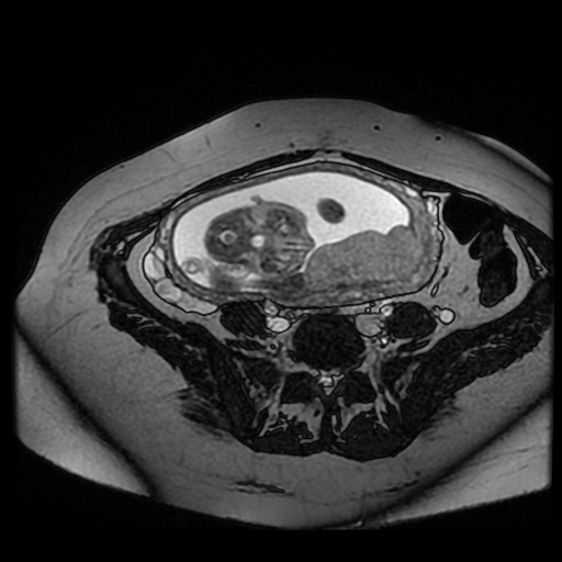Chiari II malformation - fetal MRI (Radiopaedia 68099-77581 Axial Fiesta 31).jpg