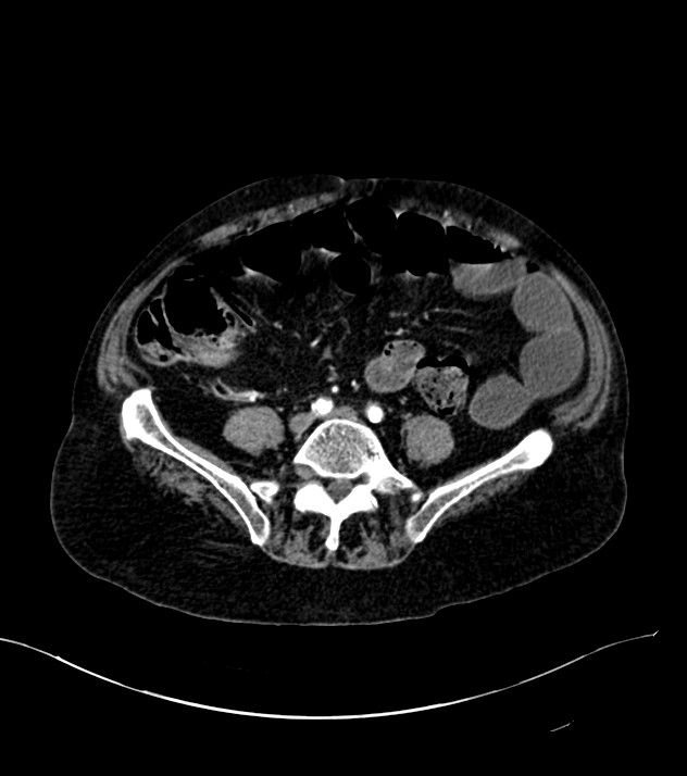 Cholangiocarcinoma with cerebral metastases (Radiopaedia 83519-98629 B 81).jpg