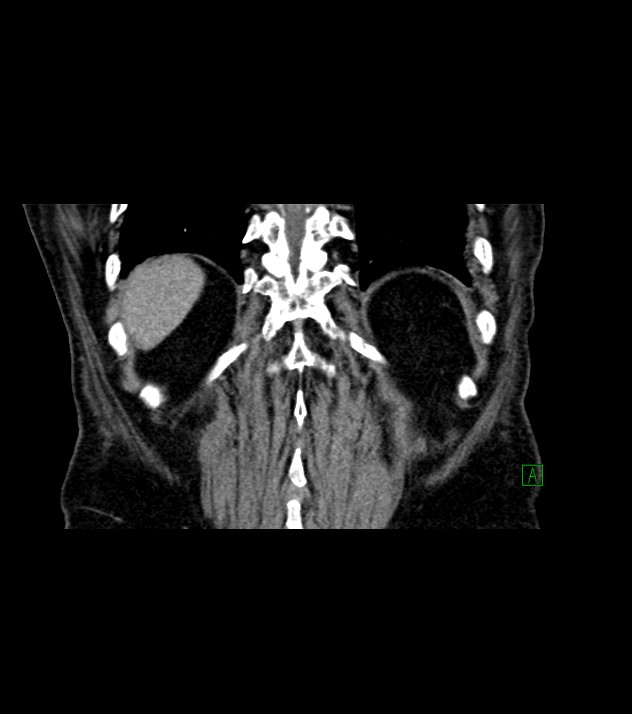 Cholangiocarcinoma with cerebral metastases (Radiopaedia 83519-98629 Coronal C+ delayed 70).jpg