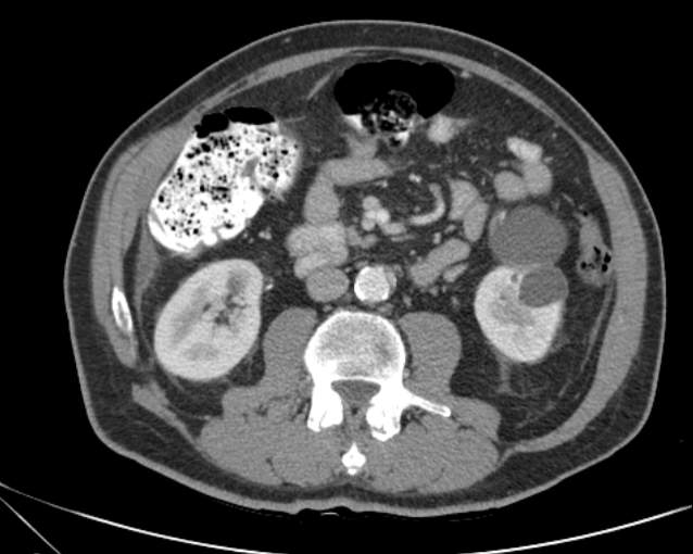 Cholecystitis - perforated gallbladder (Radiopaedia 57038-63916 A 43).jpg