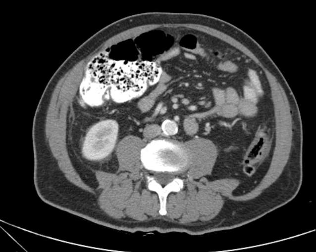 Cholecystitis - perforated gallbladder (Radiopaedia 57038-63916 A 47).jpg