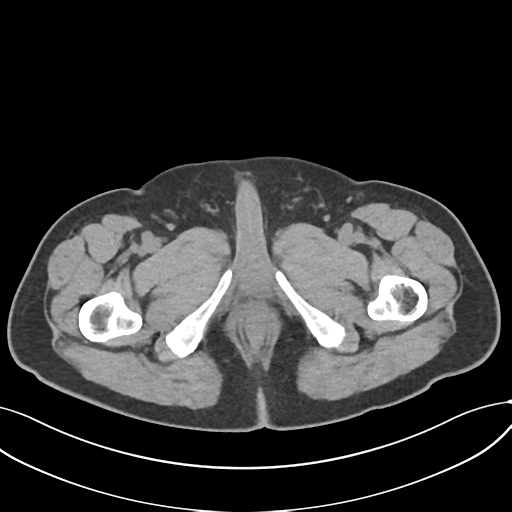 File:Cholecystitis with focal perforation and hepatic abscess (Radiopaedia 37189-38945 Axial non-contrast 92).png