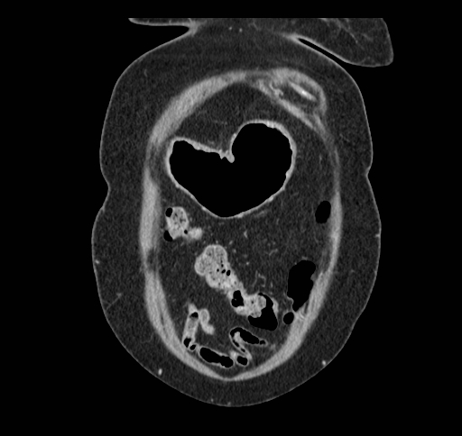 Cholecystoduodenal fistula (Radiopaedia 48959-54022 B 28).jpg