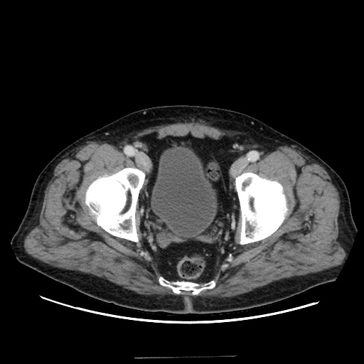 Choledocholiathiasis with normal caliber common bile duct (Radiopaedia 75368-86632 A 175).jpg