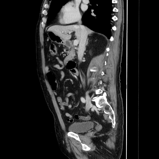 Choledocholiathiasis with normal caliber common bile duct (Radiopaedia 75368-86632 D 72).jpg