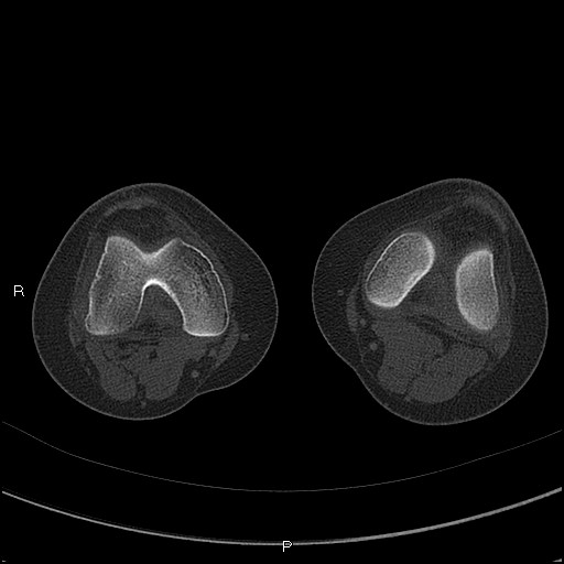 File:Chondroblastoma (Radiopaedia 62721-71030 Axial bone window 26).jpg