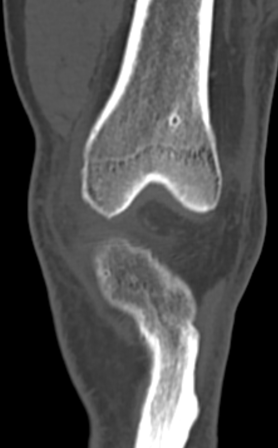 Chondrocalcinosis (Radiopaedia 82862-97173 Coronal bone window 24).jpg