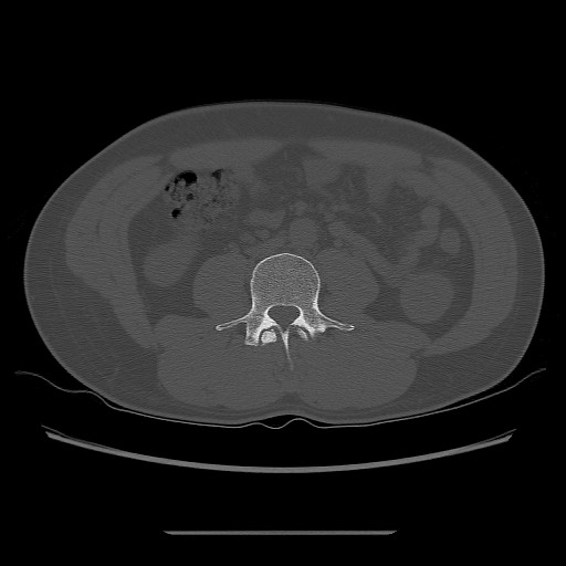 File:Chondrosarcoma of iliac wing (Radiopaedia 63861-72599 Axial bone window 5).jpg