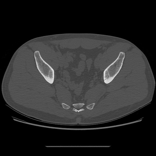 File:Chondrosarcoma of iliac wing (Radiopaedia 63861-72599 Axial bone window 81).jpg