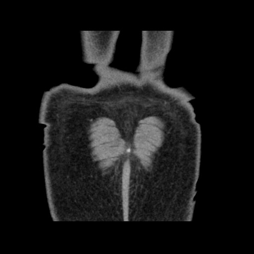 Chondrosarcoma of iliac wing (Radiopaedia 63861-72599 Coronal non-contrast 110).jpg