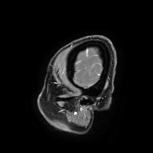 Chordoid glioma of third ventricle (Radiopaedia 91612-109340 F 188).jpg