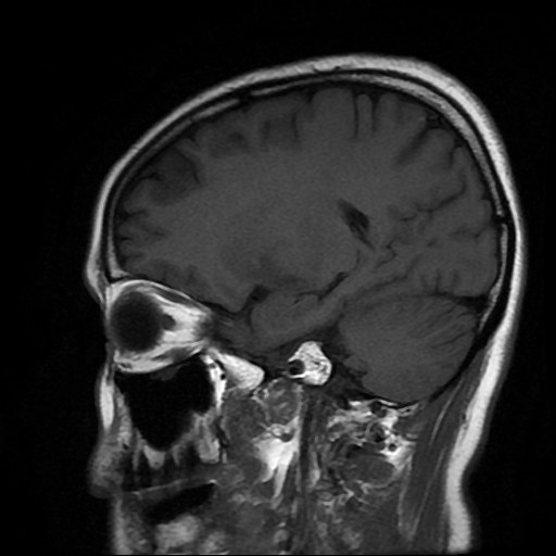 File:Chordoid glioma of third ventricle (Radiopaedia 91612-109340 Sagittal T1 8).jpg